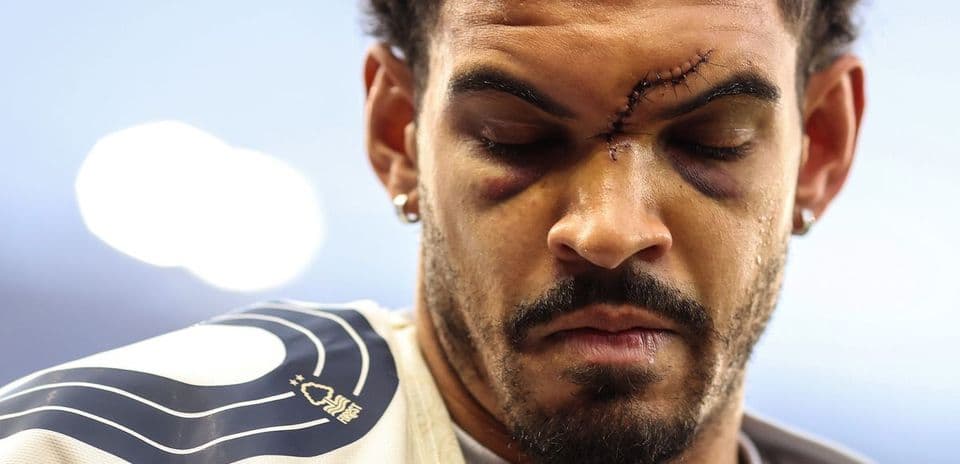 Player with facial injury and stitches on forehead